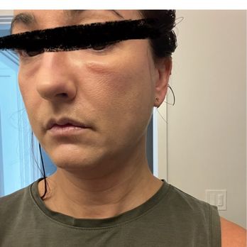 David C. Mabrie, MD - This is me in August 2022, 14 months after my initial injection - Cosmetic Surgeons Near Me - San Francisco, California