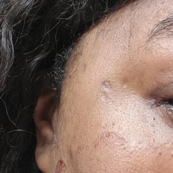 Simplicity Laser Hair Removal - Burn mark near ear