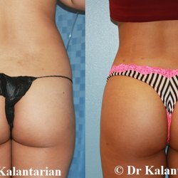 K. Plastic Cosmetic Surgery OC - Dr. Kalantarian - Brazilian Butt Lift (liposuction of upper and lower abdomen, upper and lower back, lower abdominal flanks & fat transfer to Gluteal Regions