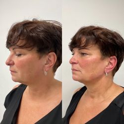 Medique - Facial contouring to lift and define