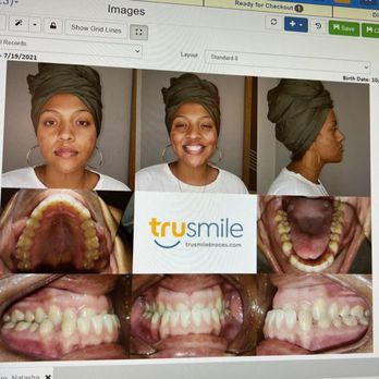 TruSmile Orthodontics - Before - Orthodontists Near Me - Culver City, California TruSmile Orthodontics - Before - Orthodontists Near Me - Culver City, California