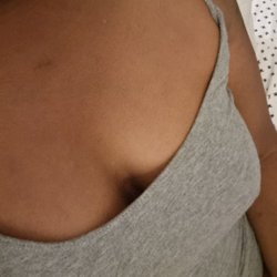 James P. Anthony, MD, FACS - Top view of my implants that was done incorrectly by Dr. Anthony resulting in smaller size implants, not what I ask for.  July/2022
