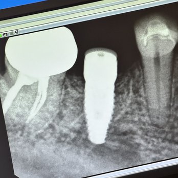 Colorado Oral Surgery Group - Implant - Oral Surgeons Near Me - Westminster, Colorado Colorado Oral Surgery Group - Implant - Oral Surgeons Near Me - Westminster, Colorado