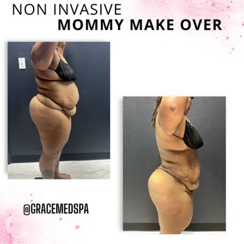 Grace MedSpa & Body Solutions - Best results with our NON INVASIVE MOMMY MAKA OVER - Body Contouring Near Me - Austin, Texas Grace MedSpa & Body Solutions - Best results with our NON INVASIVE MOMMY MAKA OVER - Body Contouring Near Me - Austin, Texas