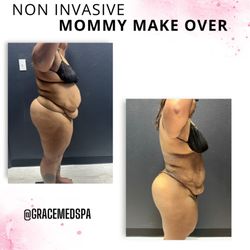 Grace MedSpa & Body Solutions - Best results with our NON INVASIVE MOMMY MAKA OVER