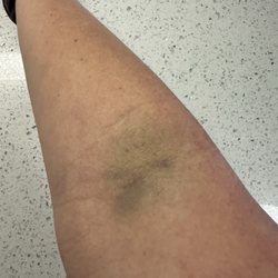 Quest Diagnostics - Pic of bruising 4 days after bloodwork