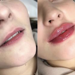 A Beautiful Look Medical Spa - Lip fillers.