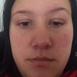 Eyebrow Centre - Right eye is swollen