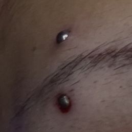 My eyebrow piercing that got embedded due to improper sizing :/ My eyebrow piercing that got embedded due to improper sizing :/