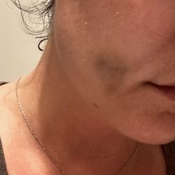Esthetic Dentistry of El Dorado Hills - Right cheek bruise after dental procedure