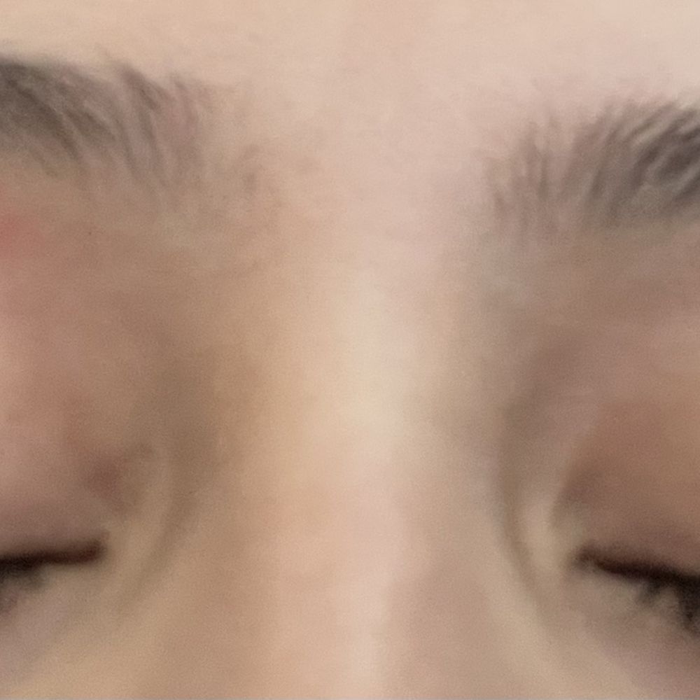 Burn after 4 hrs Burn after 4 hrs