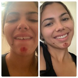 Teeth fixed Teeth fixed