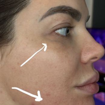 Vitalyc Medspa - Horrible thinning of skin showing prominent veins that I had to get removed. Facial fat loss, acne and redness. - Medical Spas Near Me - Dallas, Texas Vitalyc Medspa - Horrible thinning of skin showing prominent veins that I had to get removed. Facial fat loss, acne and redness. - Medical Spas Near Me - Dallas, Texas