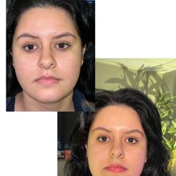 Natural Rejuvenation MedSpa - Mini FX and Ultherapy for double chin and face contouring