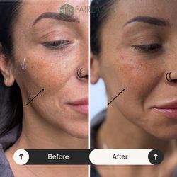 Fairlawn Aesthetic MD - Cheek enhancement by NP Tommi