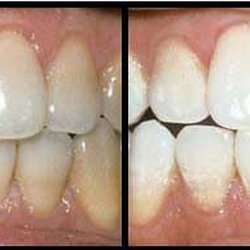 Emergency Dental - Teeth Whitening