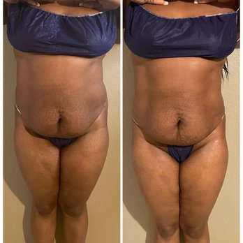 Total Transformation - Body Contouring Near Me