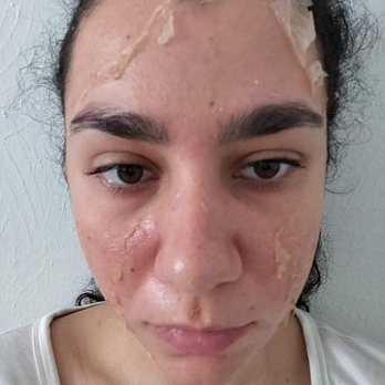 DermApproach Skin Care Clinic - My face during peeling. - Laser Hair Removal Near Me - Reston, Virginia DermApproach Skin Care Clinic - My face during peeling. - Laser Hair Removal Near Me - Reston, Virginia