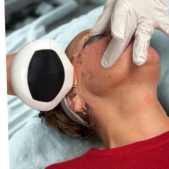 Iris Beauty Solution - Lumecca IPL Dark Sun Spots Treatment - Laser Hair Removal Near Me - Vancouver, British Columbia Iris Beauty Solution - Lumecca IPL Dark Sun Spots Treatment - Laser Hair Removal Near Me - Vancouver, British Columbia