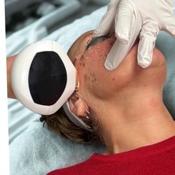Iris Beauty Solution - Lumecca IPL Dark Sun Spots Treatment