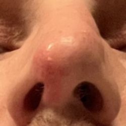 Roseville Facial Plastic Surgery - Nostrils and septum are distorted