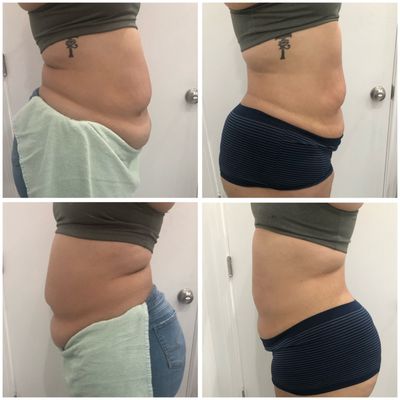 Waisted Body Contouring