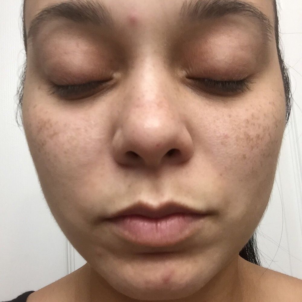 Selah Skin Studio - Before my facial - Skin Care Near Me - Miami Lakes, Florida Selah Skin Studio - Before my facial - Skin Care Near Me - Miami Lakes, Florida