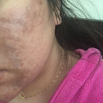Skincare By Lori - I got my peel done on a Tuesday this was Wednesday night - Skin Care Near Me - Newport Beach, California Skincare By Lori - I got my peel done on a Tuesday this was Wednesday night - Skin Care Near Me - Newport Beach, California