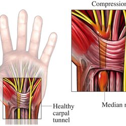 Huesero Sobador Terapeuta Holístico - Problemas de Tunel Carpal.