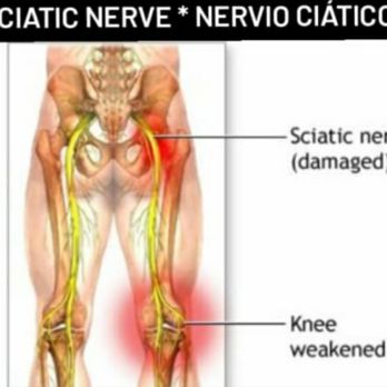 GG Massage - Sciatic nerve - Massage Therapy Near Me - McAllen, Texas
