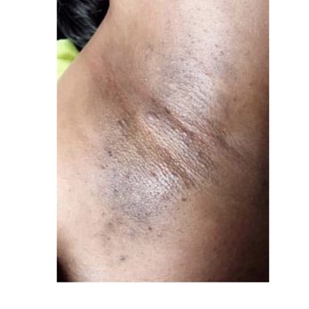 SMH Wax - Underarms after - Waxing Near Me - Houston, Texas SMH Wax - Underarms after - Waxing Near Me - Houston, Texas