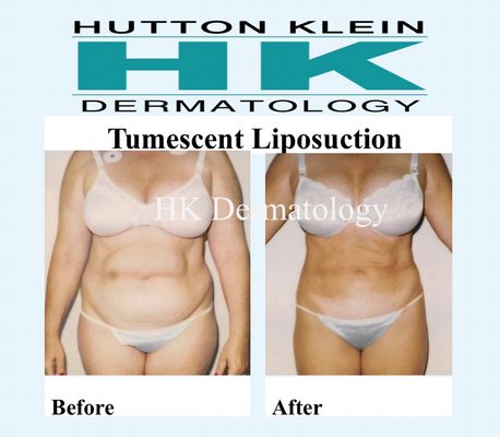 Tumescent Liposuction - Tumescent liposuction is a fat removal procedure that doesn’t require general anesthesia or IV sedation and is performed in HK Dermatology’s office-based surgical suites as an outpatient treatment. Tumescent liposuction is less painful and has a quicker recovery time than traditional methods of liposuction, and is often less painful than some non-invasive fat removal procedures such as Coolsculpt. The pain of Coolsculpt is often significantly greater than the mere soreness that patients experience after Tumescent Liposuction. The average patient can return to work in two days, return to light exercise within a week, and wears the compression garments for under a week. Because there’s no risk from general anesthesia, tumescent liposuction is safer than traditional liposuction methods and is the gold standard worldwide. Tumescent Liposuction - Tumescent liposuction is a fat removal procedure that doesn’t require general anesthesia or IV sedation and is performed in HK Dermatology’s office-based surgical suites as an outpatient treatment. Tumescent liposuction is less painful and has a quicker recovery time than traditional methods of liposuction, and is often less painful than some non-invasive fat removal procedures such as Coolsculpt. The pain of Coolsculpt is often significantly greater than the mere soreness that patients experience after Tumescent Liposuction. The average patient can return to work in two days, return to light exercise within a week, and wears the compression garments for under a week. Because there’s no risk from general anesthesia, tumescent liposuction is safer than traditional liposuction methods and is the gold standard worldwide.