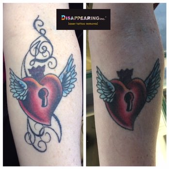 Removery - Sometimes you just don't want a piece of your tattoo. - Tattoo Removal Near Me - Lawrence, Massachusetts Removery - Sometimes you just don't want a piece of your tattoo. - Tattoo Removal Near Me - Lawrence, Massachusetts
