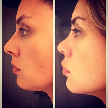 Edward H Park, MD - Before and After (5 Months Post-Op)! - Cosmetic Surgeons Near Me - Upland, California