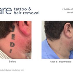 Bare Tattoo & Hair Removal - Black ink laser tattoo removal by Bare Tattoo & Hair Removal. Clinics in Chicago's Loop, South Loop, and Munster, Indiana.