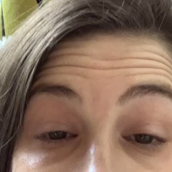 Peachy - Before Botox - wow this is a great picture of me - Skin Care Near Me - New York, New York