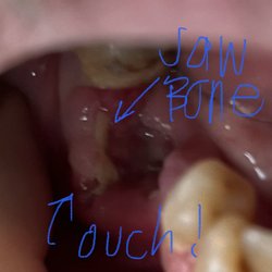 Denton Smiles Dentistry - This is my jawbone, the lower portion is so sharp it recuts the tissue around it