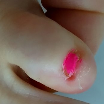 KK Nails - Cut the skin and let it bleed. - Nail Salons Near Me - American Fork, Utah KK Nails - Cut the skin and let it bleed. - Nail Salons Near Me - American Fork, Utah