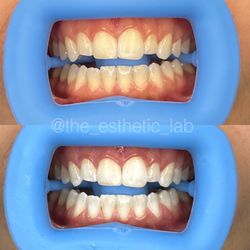 The Esthetic Lab - Before & After 1 Teeth Whitening Session
