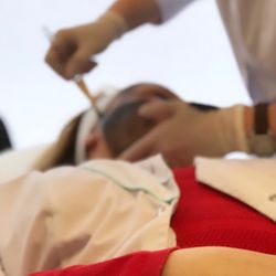 Aesthetic Allure Laser & Skin Center - Carbon laser