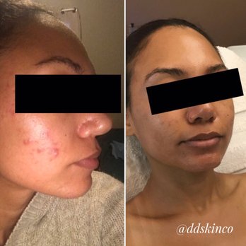Dew Diligence Skincare & Aesthetics - My real before and after pictures! Thank you Jen! - Skin Care Near Me - Lakeport, California Dew Diligence Skincare & Aesthetics - My real before and after pictures! Thank you Jen! - Skin Care Near Me - Lakeport, California