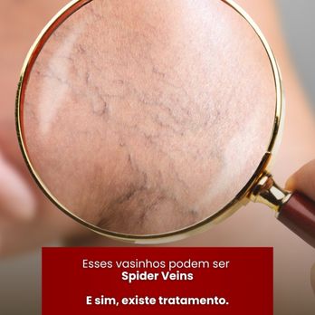 Fenix Beauty Spa - Spider veins Treatment - Skin Care Near Me - Medford, Massachusetts Fenix Beauty Spa - Spider veins Treatment - Skin Care Near Me - Medford, Massachusetts