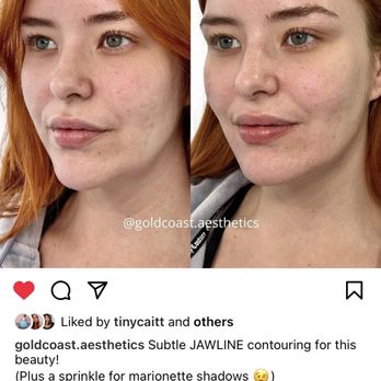 Gold Coast Aesthetics - Before and After - Medical Spas Near Me - Costa Mesa, California Gold Coast Aesthetics - Before and After - Medical Spas Near Me - Costa Mesa, California