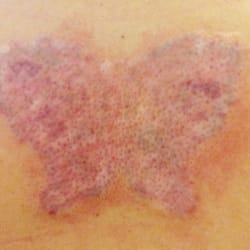 InkOff MD - Right after laser treatment: No bleeding & very litle swelling.