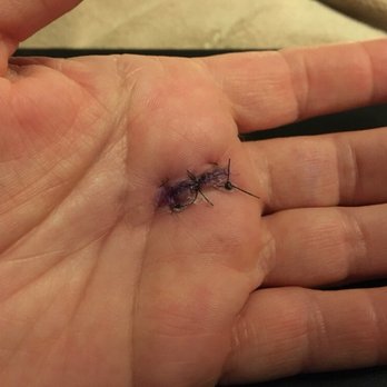 Frederick D. Scott Jr, MD - Six days post-op for trigger finger release performed by Dr. Scott. Nice job! - Orthopedists Near Me - McLean, Virginia Frederick D. Scott Jr, MD - Six days post-op for trigger finger release performed by Dr. Scott. Nice job! - Orthopedists Near Me - McLean, Virginia