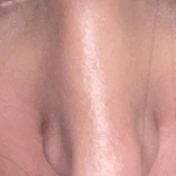 Raj Kanodia Plastic Surgery - Crooked nose - Plastic Surgeons Near Me - Beverly Hills, California Raj Kanodia Plastic Surgery - Crooked nose - Plastic Surgeons Near Me - Beverly Hills, California