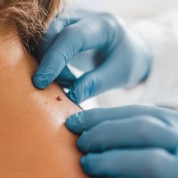 Premier Laser & Aesthetics - Skin tag removal with the laser