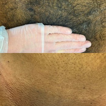 Skin Esteem - Before & After bikini wax - Waxing Near Me - Castro Valley, California Skin Esteem - Before & After bikini wax - Waxing Near Me - Castro Valley, California
