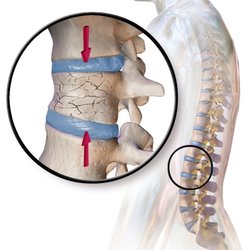 Kevin D Richardson, DO - San Antonio Spine Center - Compression Fractures