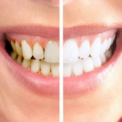 Your Covina Family Dentistry - zoom laser teeth whitening